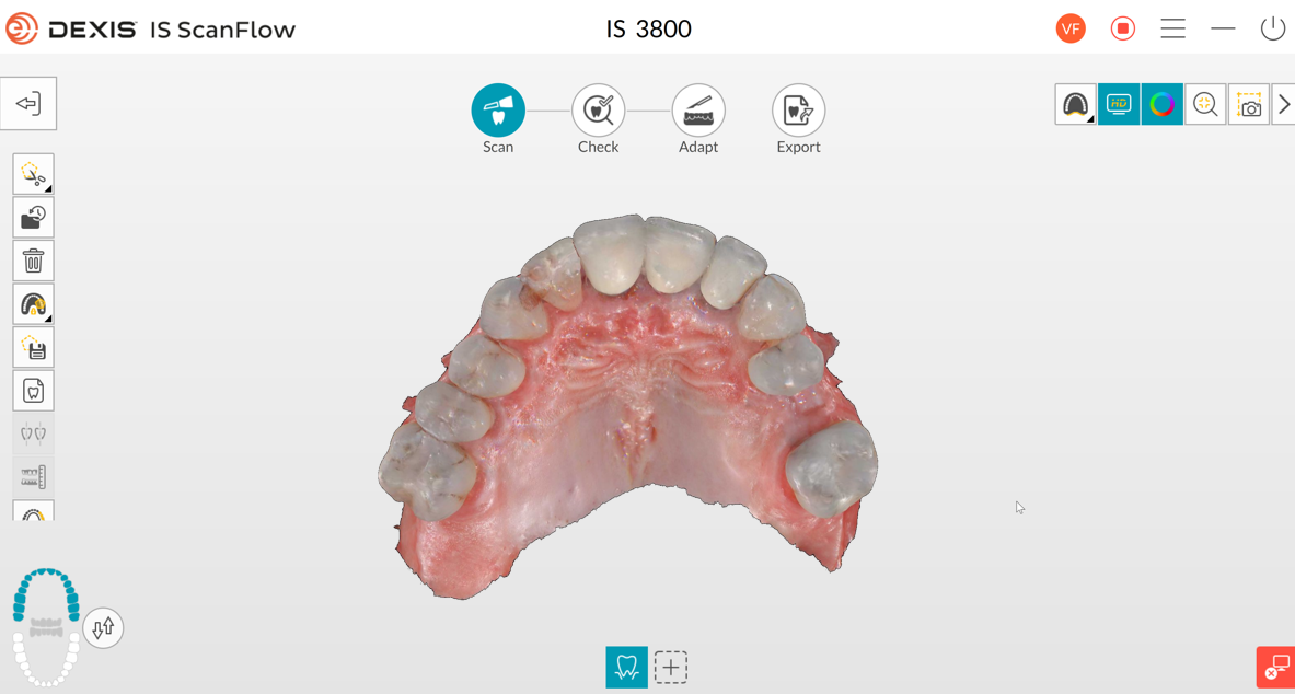 Digital impression of the initial situation: superior arch. A fully guided digital workflow for predictable implant planning and placement