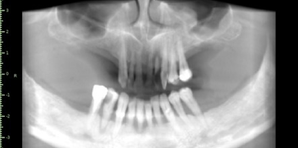 CBCT.