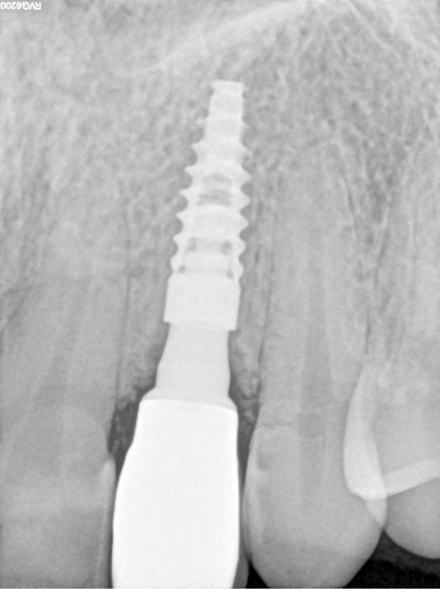 FIG. 25 Three years RX of tooth #22.