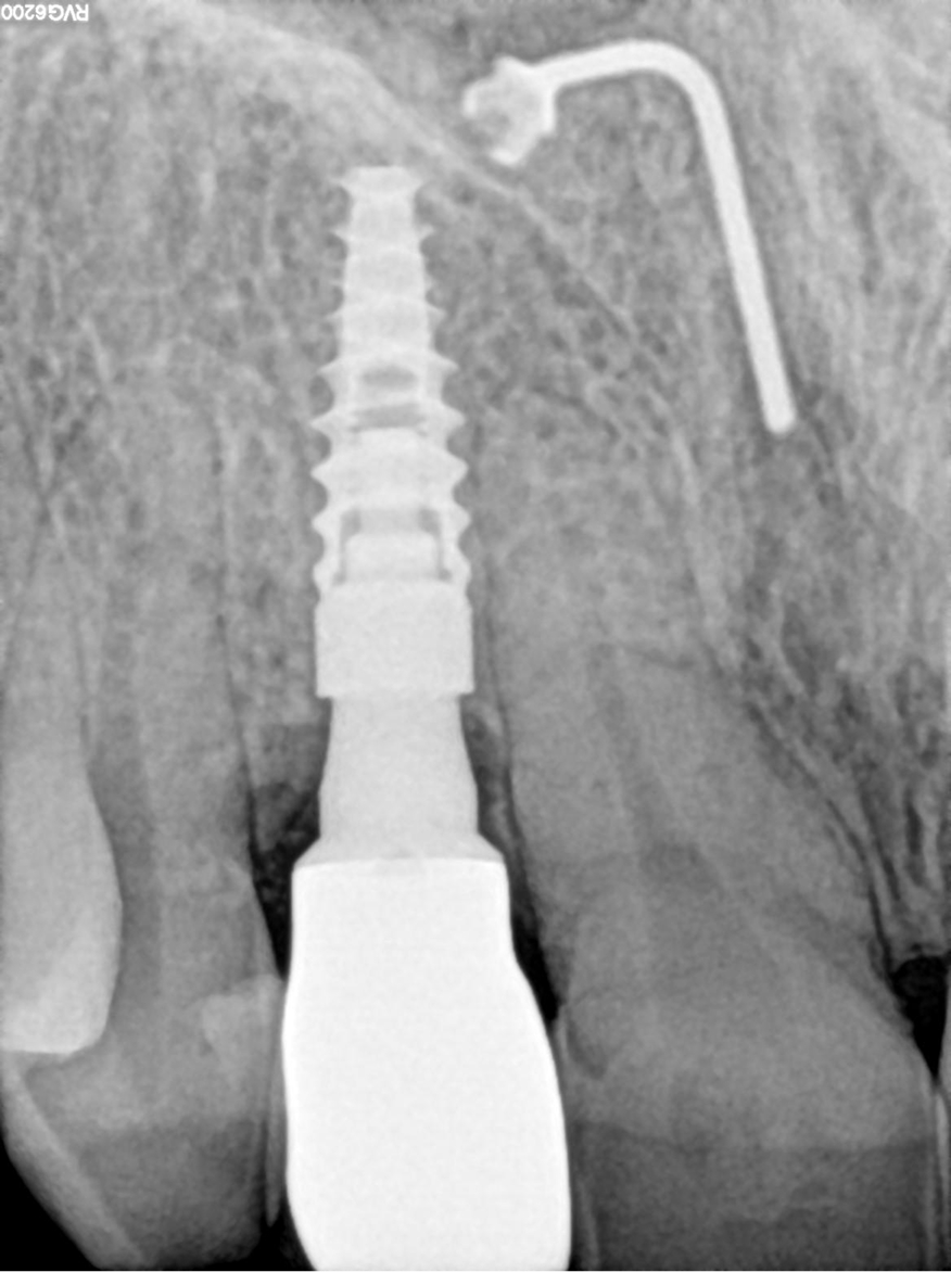 FIG. 24 Three years RX of tooth #12.
