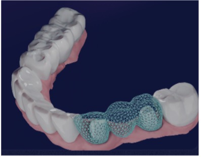 FIG. 1 AI-powered bridge design created with DentaBRIDGE