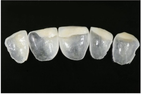 FIG. 2 AI-designed veneers created with DentaBRIDGE