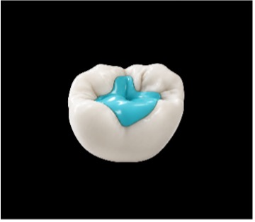 FIG. 3 AI-designed inlay created with DentaBRIDGE